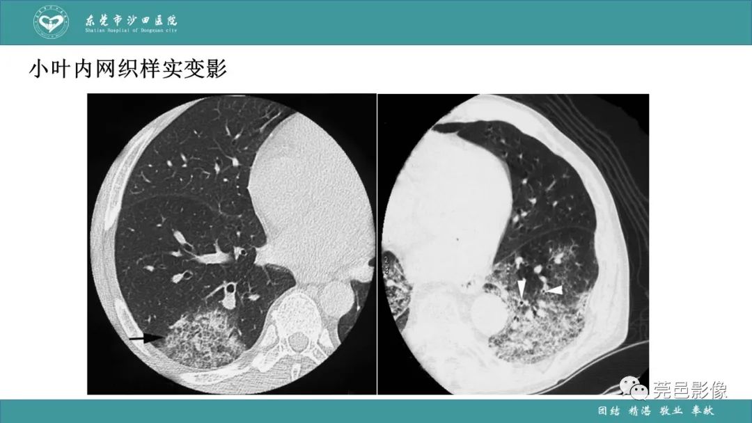 影像PPT - 【PPT】肺炎克雷伯杆菌肺炎影像学诊断与鉴别诊断-35
