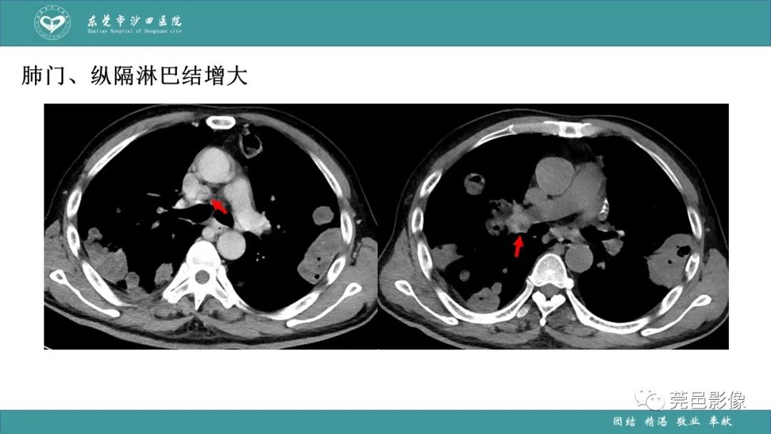 影像PPT - 【PPT】肺炎克雷伯杆菌肺炎影像学诊断与鉴别诊断-36