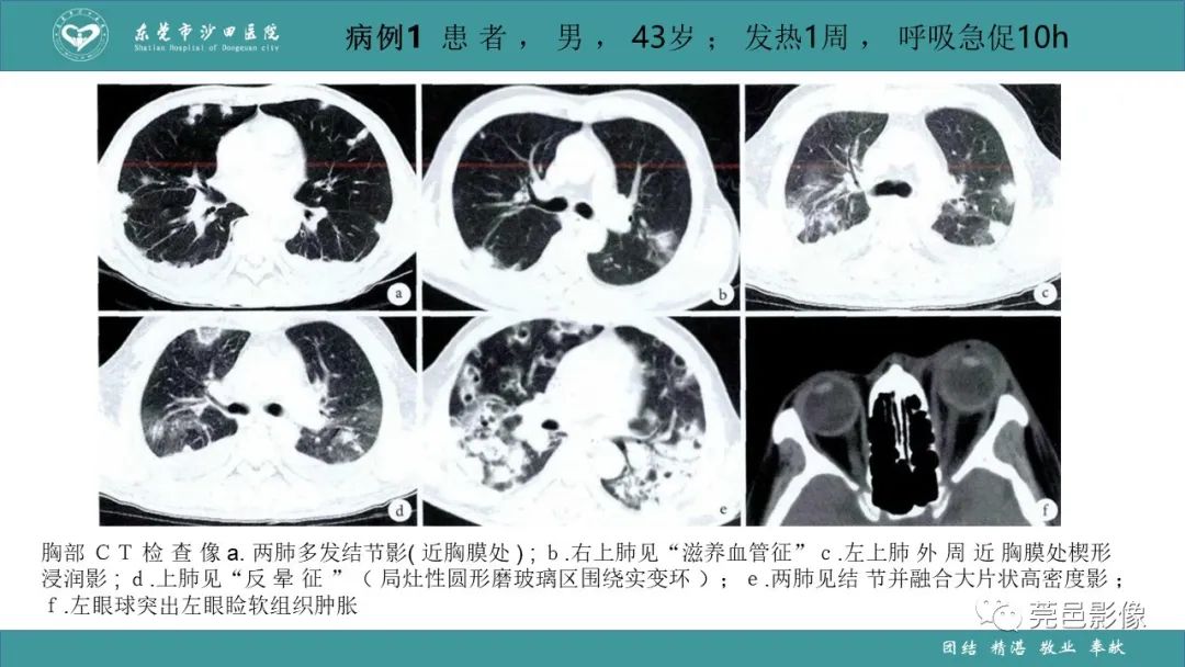 影像PPT - 【PPT】肺炎克雷伯杆菌肺炎影像学诊断与鉴别诊断-38