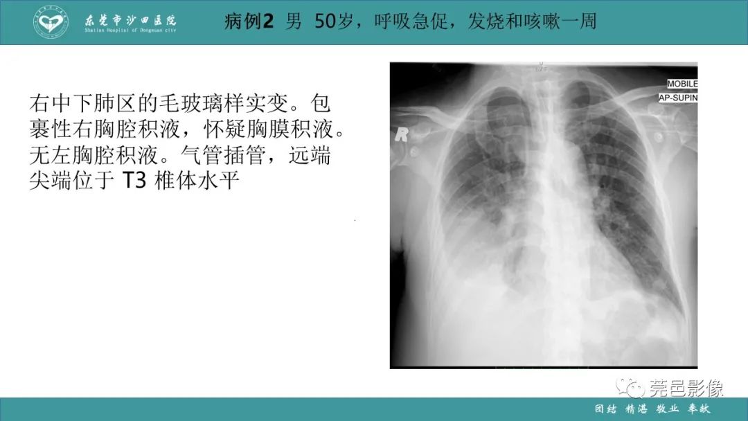 影像PPT - 【PPT】肺炎克雷伯杆菌肺炎影像学诊断与鉴别诊断-39