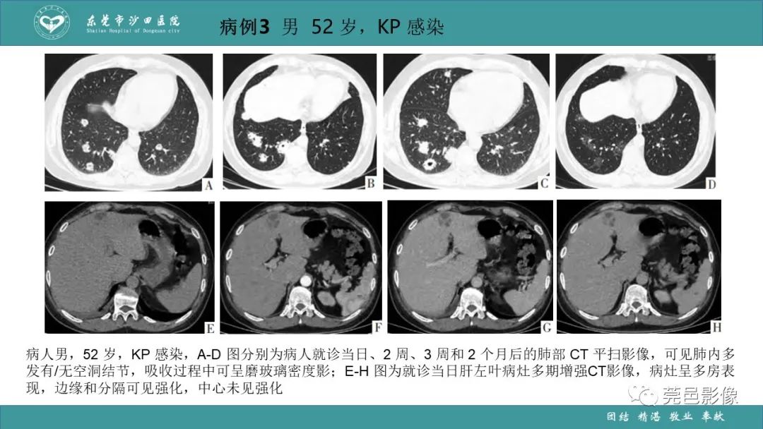 影像PPT - 【PPT】肺炎克雷伯杆菌肺炎影像学诊断与鉴别诊断-41