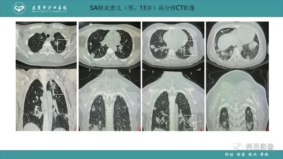 影像PPT - 【PPT】肺炎克雷伯杆菌肺炎影像学诊断与鉴别诊断-45