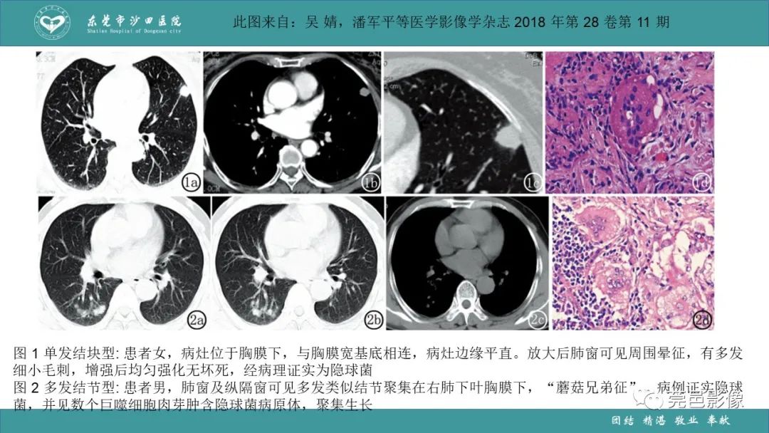影像PPT - 【PPT】肺炎克雷伯杆菌肺炎影像学诊断与鉴别诊断-47