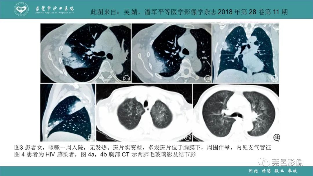 影像PPT - 【PPT】肺炎克雷伯杆菌肺炎影像学诊断与鉴别诊断-48