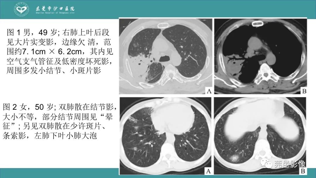 影像PPT - 【PPT】肺炎克雷伯杆菌肺炎影像学诊断与鉴别诊断-50