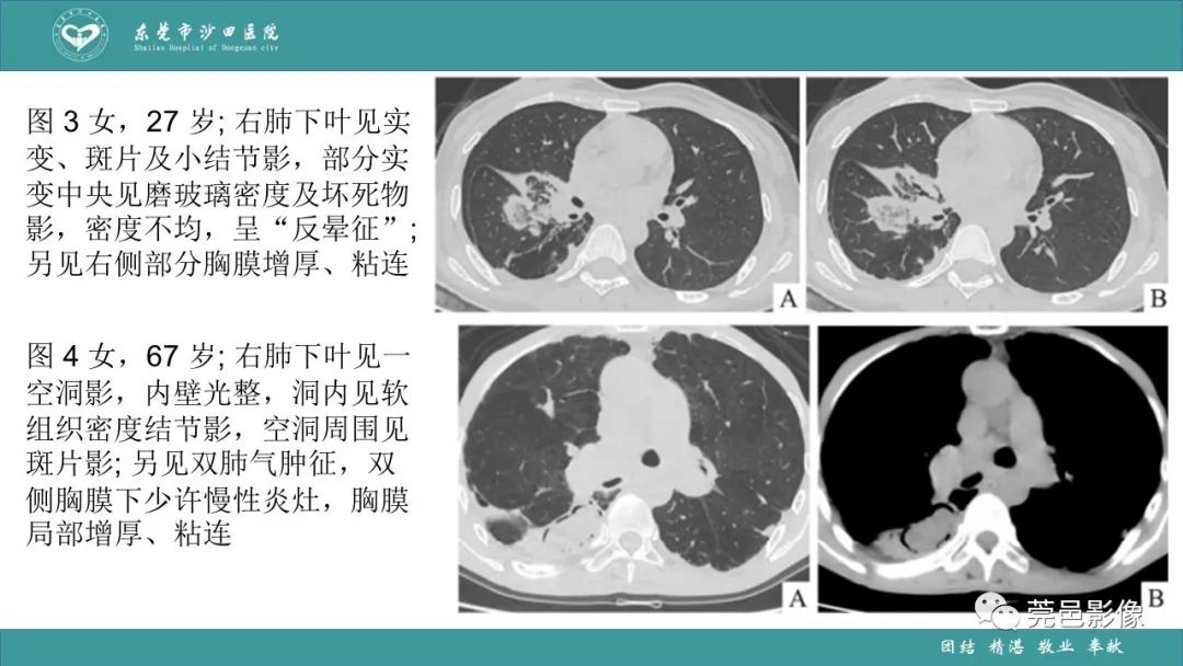 影像PPT - 【PPT】肺炎克雷伯杆菌肺炎影像学诊断与鉴别诊断-51