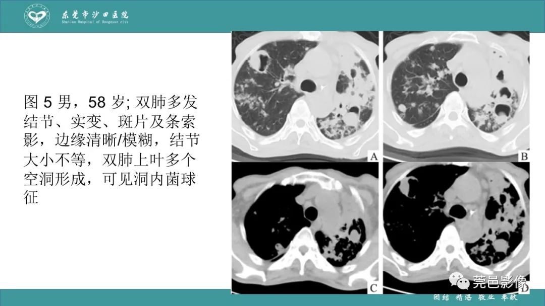 影像PPT - 【PPT】肺炎克雷伯杆菌肺炎影像学诊断与鉴别诊断-52