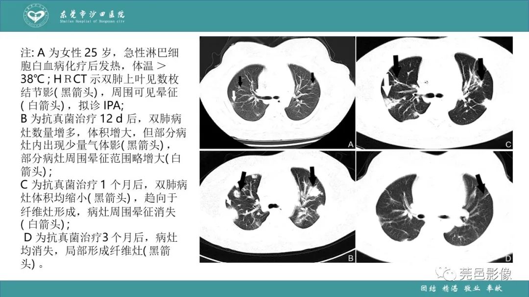 影像PPT - 【PPT】肺炎克雷伯杆菌肺炎影像学诊断与鉴别诊断-54