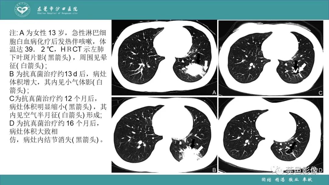 影像PPT - 【PPT】肺炎克雷伯杆菌肺炎影像学诊断与鉴别诊断-55