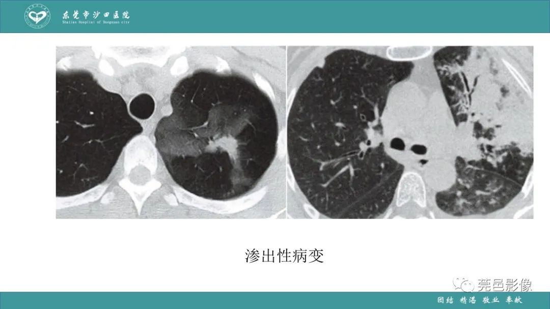影像PPT - 【PPT】肺炎克雷伯杆菌肺炎影像学诊断与鉴别诊断-57