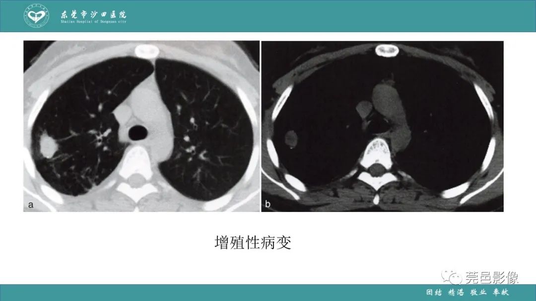 影像PPT - 【PPT】肺炎克雷伯杆菌肺炎影像学诊断与鉴别诊断-58