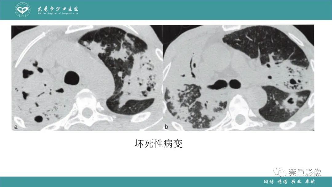 影像PPT - 【PPT】肺炎克雷伯杆菌肺炎影像学诊断与鉴别诊断-59