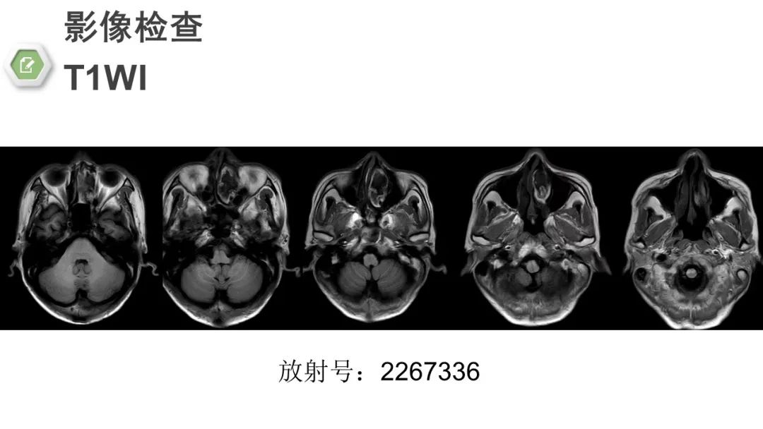 影像PPT - 【病例】颅底骨化性纤维瘤1例CT及MR影像-3 影像PPT - 【病例】颅底骨化性纤维瘤1例CT及MR影像-3