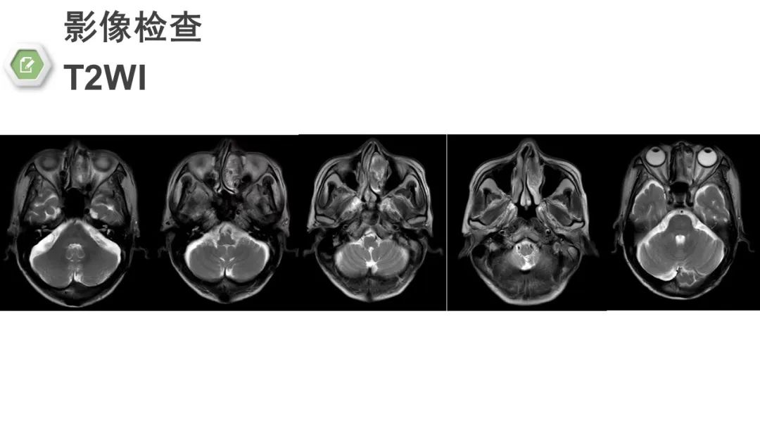 影像PPT - 【病例】颅底骨化性纤维瘤1例CT及MR影像-4 影像PPT - 【病例】颅底骨化性纤维瘤1例CT及MR影像-4