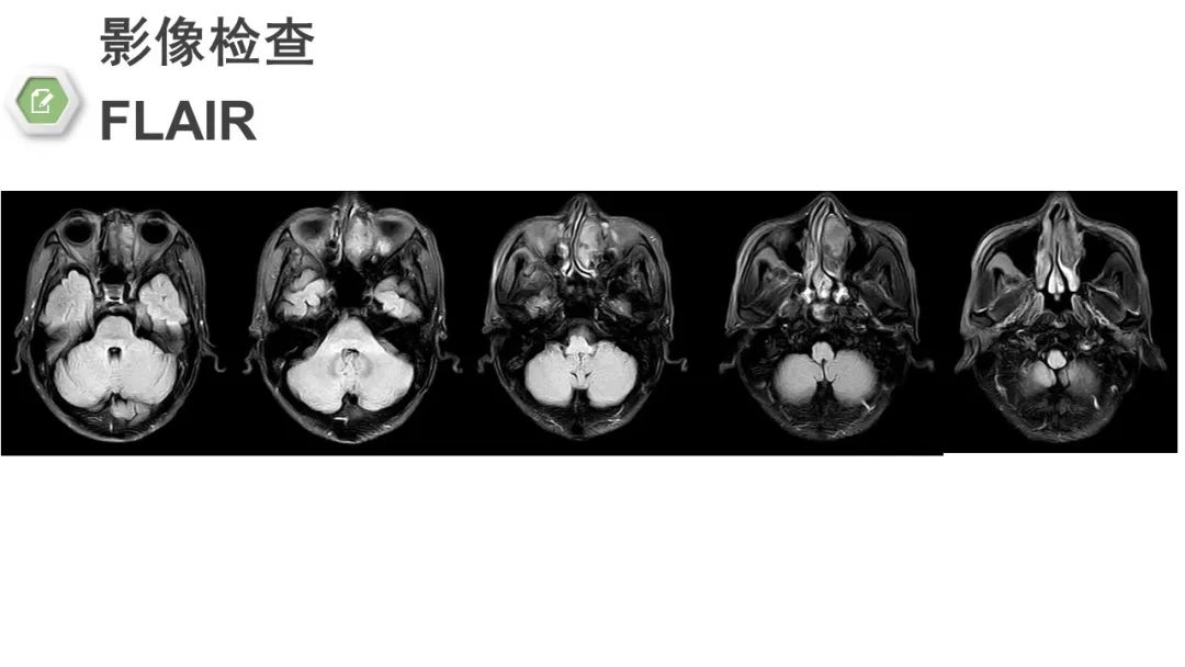 影像PPT - 【病例】颅底骨化性纤维瘤1例CT及MR影像-5 影像PPT - 【病例】颅底骨化性纤维瘤1例CT及MR影像-5