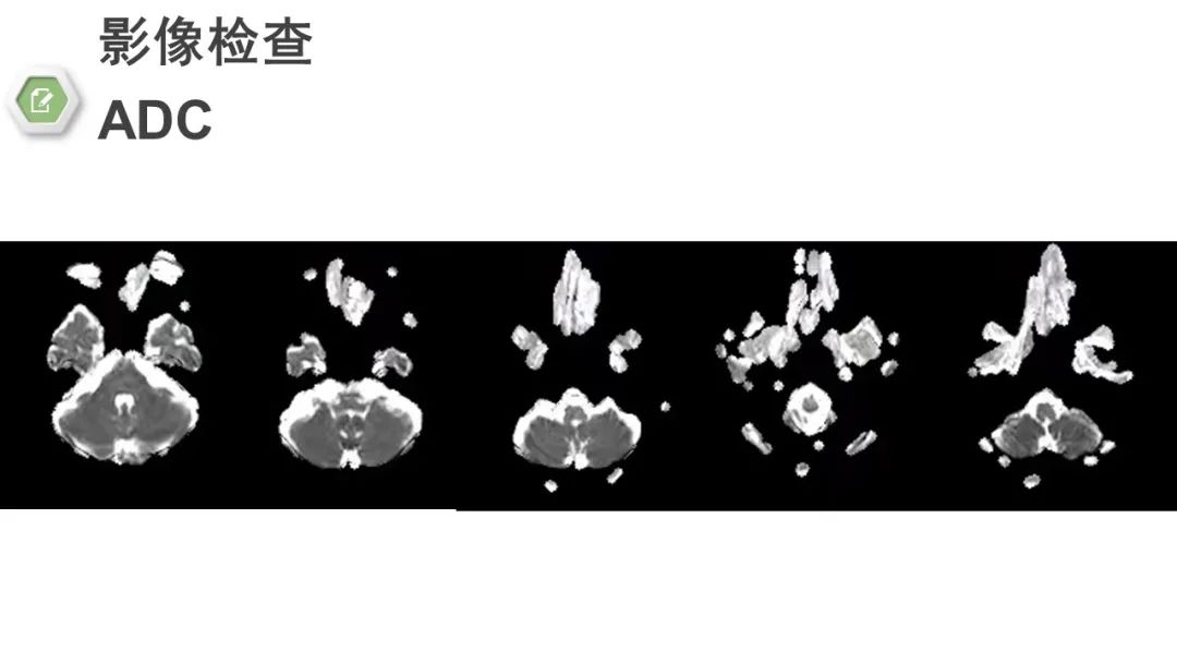 影像PPT - 【病例】颅底骨化性纤维瘤1例CT及MR影像-7 影像PPT - 【病例】颅底骨化性纤维瘤1例CT及MR影像-7