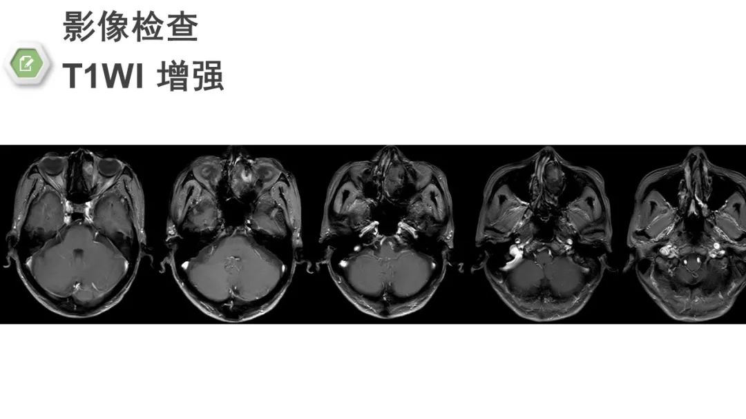 影像PPT - 【病例】颅底骨化性纤维瘤1例CT及MR影像-8 影像PPT - 【病例】颅底骨化性纤维瘤1例CT及MR影像-8