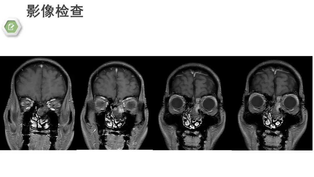 影像PPT - 【病例】颅底骨化性纤维瘤1例CT及MR影像-9 影像PPT - 【病例】颅底骨化性纤维瘤1例CT及MR影像-9