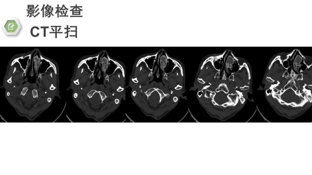影像PPT - 【病例】颅底骨化性纤维瘤1例CT及MR影像-10 影像PPT - 【病例】颅底骨化性纤维瘤1例CT及MR影像-10