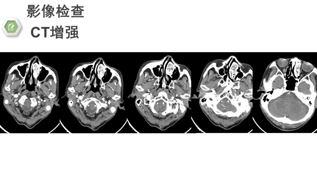 影像PPT - 【病例】颅底骨化性纤维瘤1例CT及MR影像-11 影像PPT - 【病例】颅底骨化性纤维瘤1例CT及MR影像-11