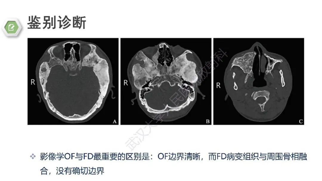 影像PPT - 【病例】颅底骨化性纤维瘤1例CT及MR影像-20 影像PPT - 【病例】颅底骨化性纤维瘤1例CT及MR影像-20