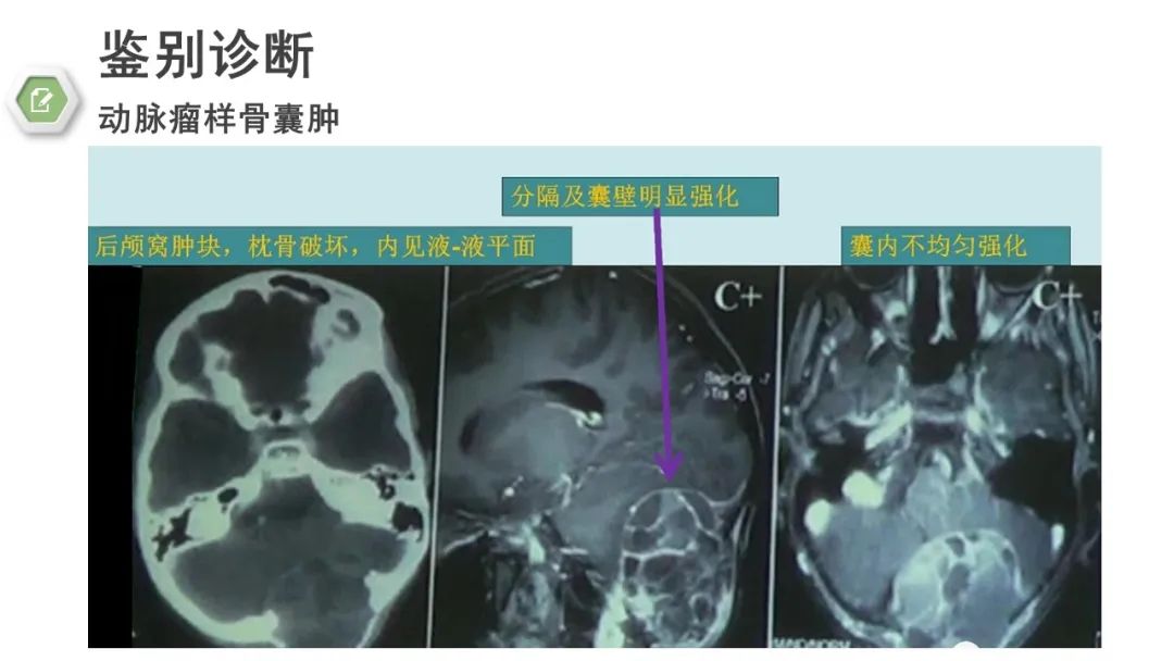 影像PPT - 【病例】颅底骨化性纤维瘤1例CT及MR影像-22 影像PPT - 【病例】颅底骨化性纤维瘤1例CT及MR影像-22