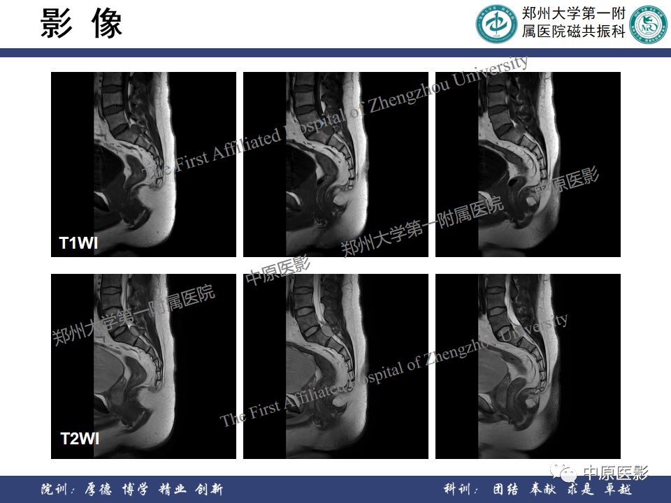 影像PPT - 【病例】脊柱硬膜外血管瘤1例MR影像-3