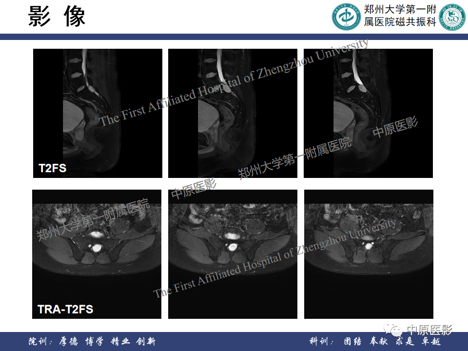 影像PPT - 【病例】脊柱硬膜外血管瘤1例MR影像-4