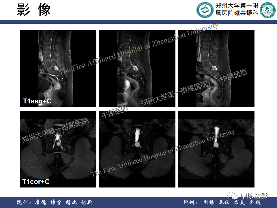 影像PPT - 【病例】脊柱硬膜外血管瘤1例MR影像-5