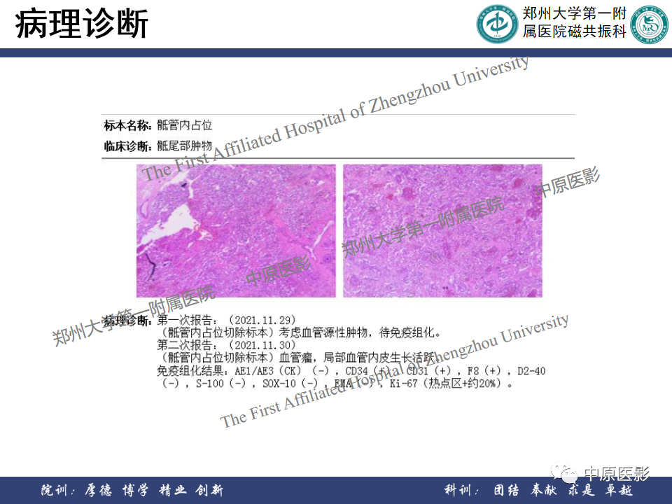 影像PPT - 【病例】脊柱硬膜外血管瘤1例MR影像-8