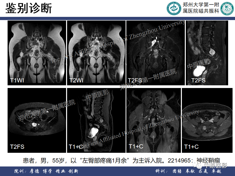 影像PPT - 【病例】脊柱硬膜外血管瘤1例MR影像-11