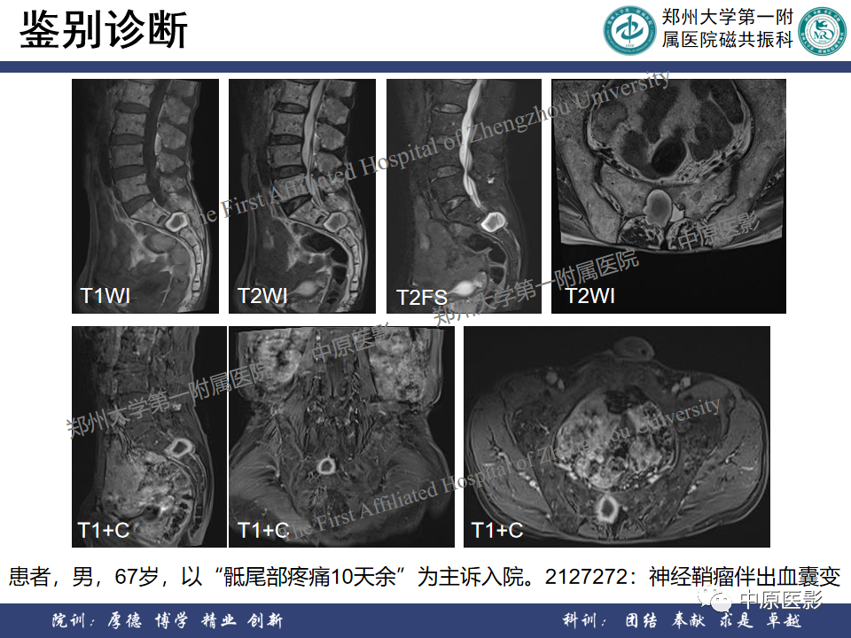 影像PPT - 【病例】脊柱硬膜外血管瘤1例MR影像-12