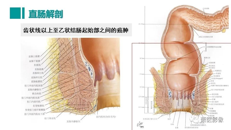 影像PPT - 【PPT】直肠癌影像学评价-9