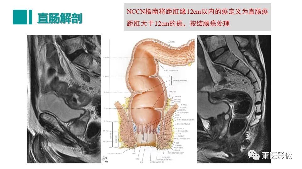 影像PPT - 【PPT】直肠癌影像学评价-10
