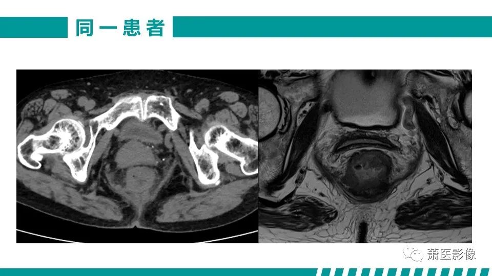 影像PPT - 【PPT】直肠癌影像学评价-14