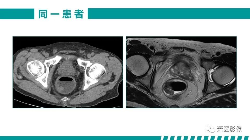 影像PPT - 【PPT】直肠癌影像学评价-15