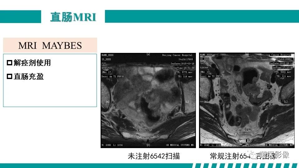 影像PPT - 【PPT】直肠癌影像学评价-20