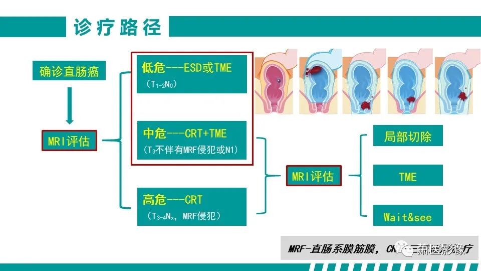 影像PPT - 【PPT】直肠癌影像学评价-24