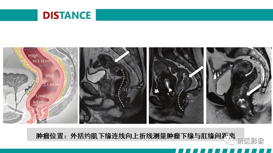 影像PPT - 【PPT】直肠癌影像学评价-27