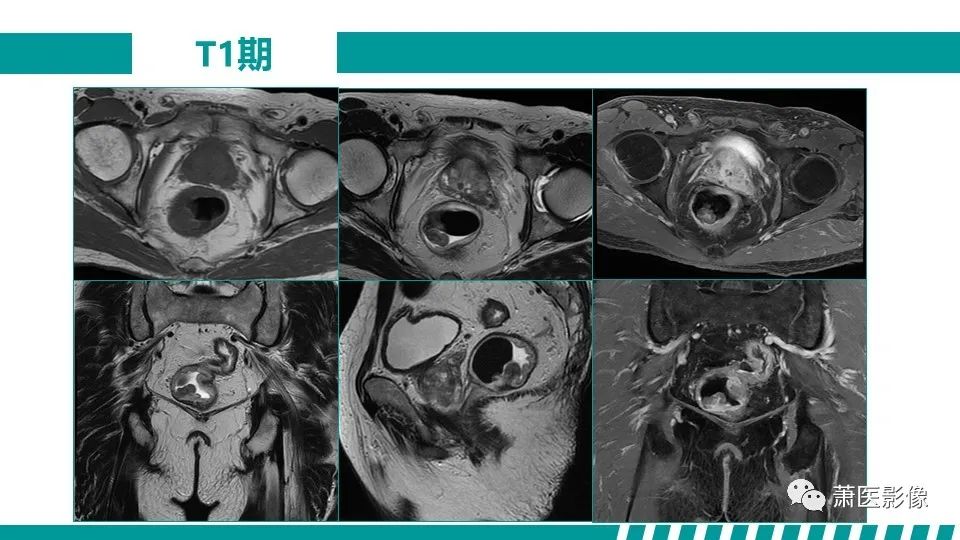 影像PPT - 【PPT】直肠癌影像学评价-30