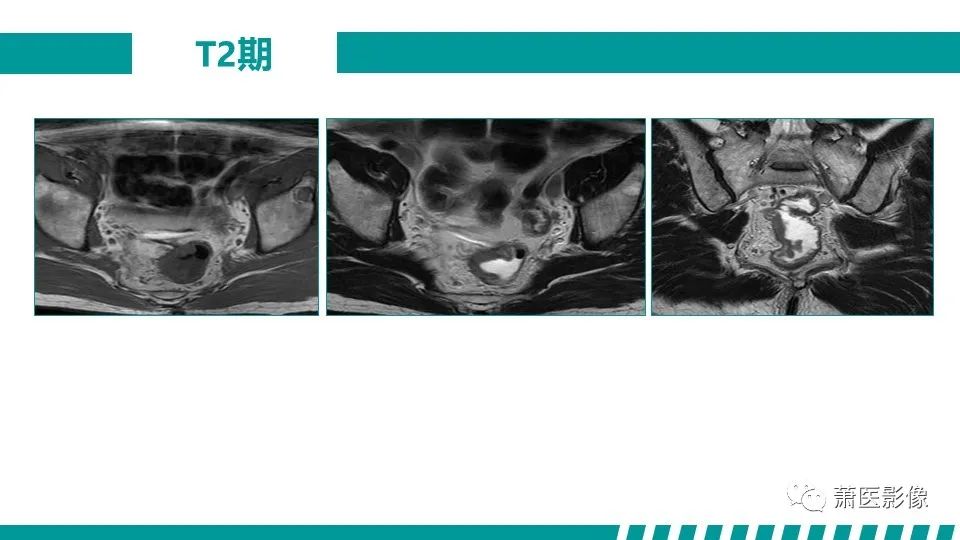 影像PPT - 【PPT】直肠癌影像学评价-31