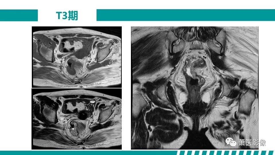 影像PPT - 【PPT】直肠癌影像学评价-32