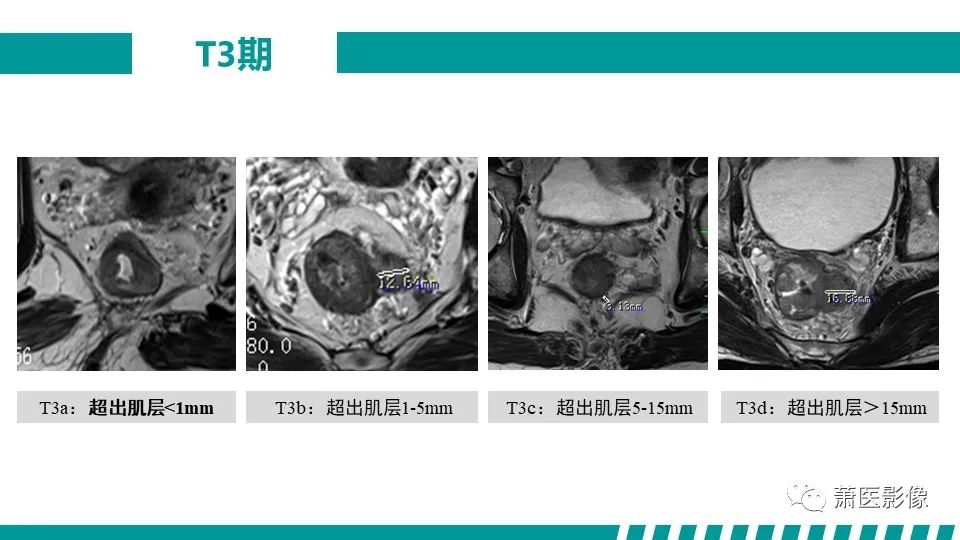 影像PPT - 【PPT】直肠癌影像学评价-33