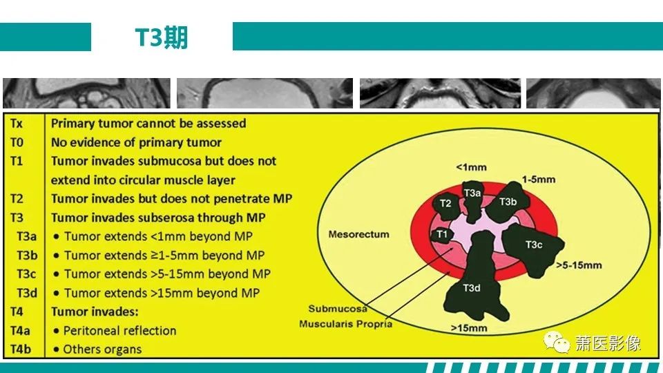 影像PPT - 【PPT】直肠癌影像学评价-34