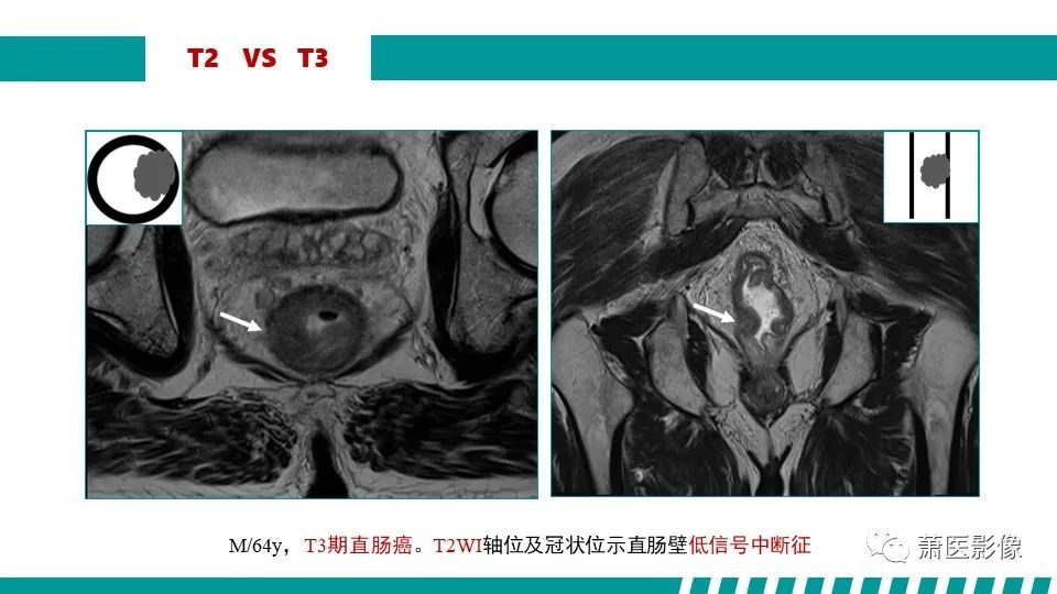影像PPT - 【PPT】直肠癌影像学评价-36