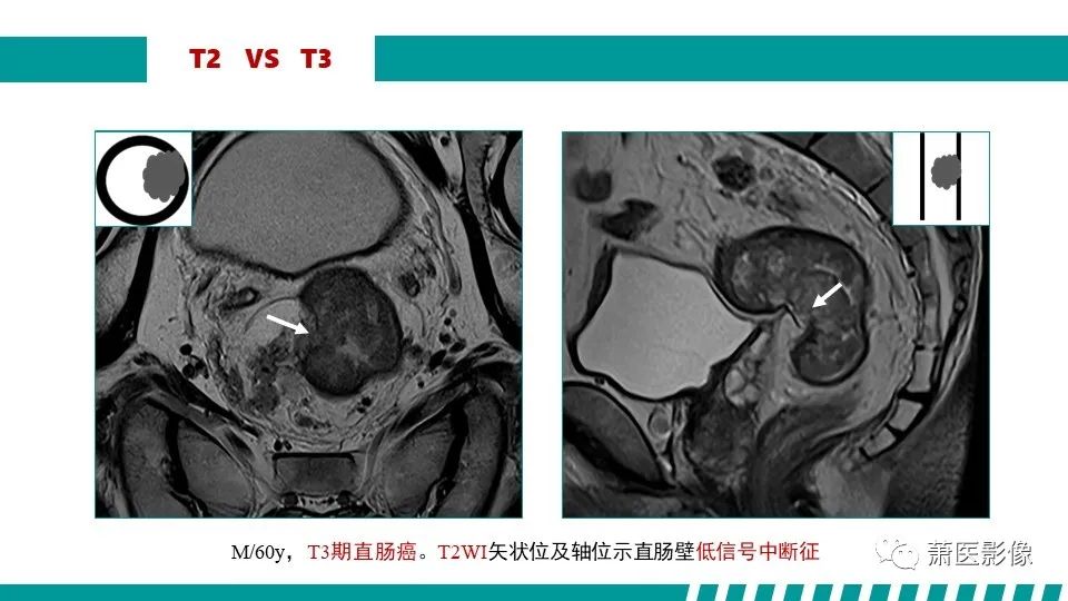 影像PPT - 【PPT】直肠癌影像学评价-37