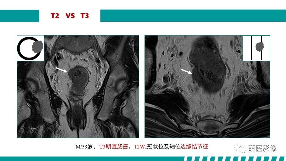 影像PPT - 【PPT】直肠癌影像学评价-38