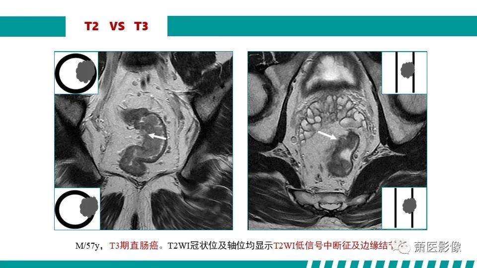 影像PPT - 【PPT】直肠癌影像学评价-39