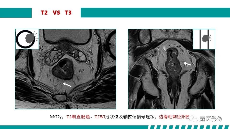影像PPT - 【PPT】直肠癌影像学评价-40