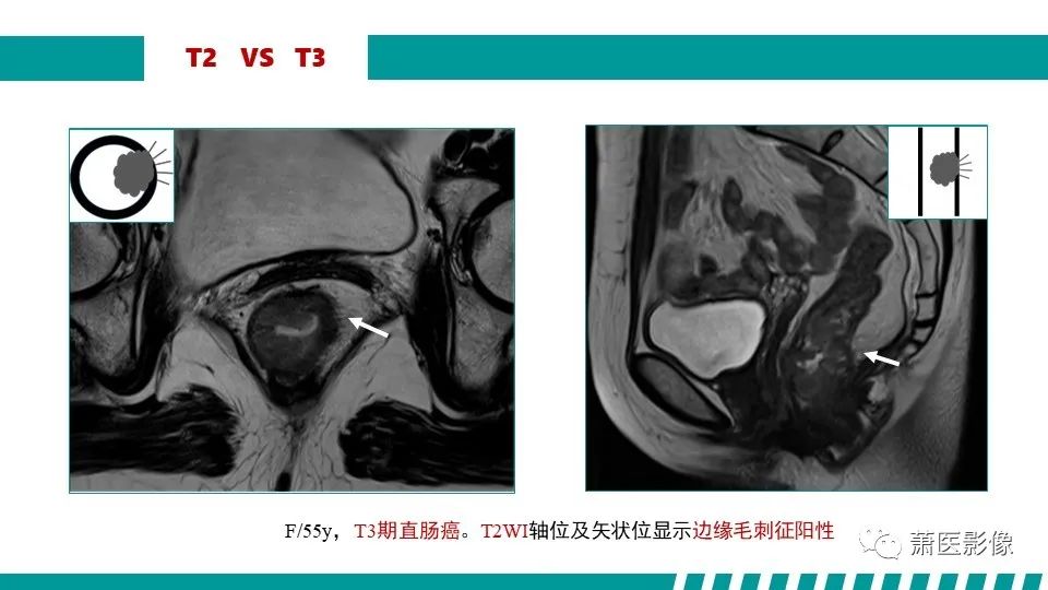 影像PPT - 【PPT】直肠癌影像学评价-41